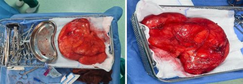 One Kilogram Lipoma Removed from the Back – Restoring Mobility